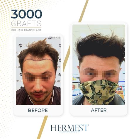 hermest hair transplant|hermest hair transplant clinic istanbul.